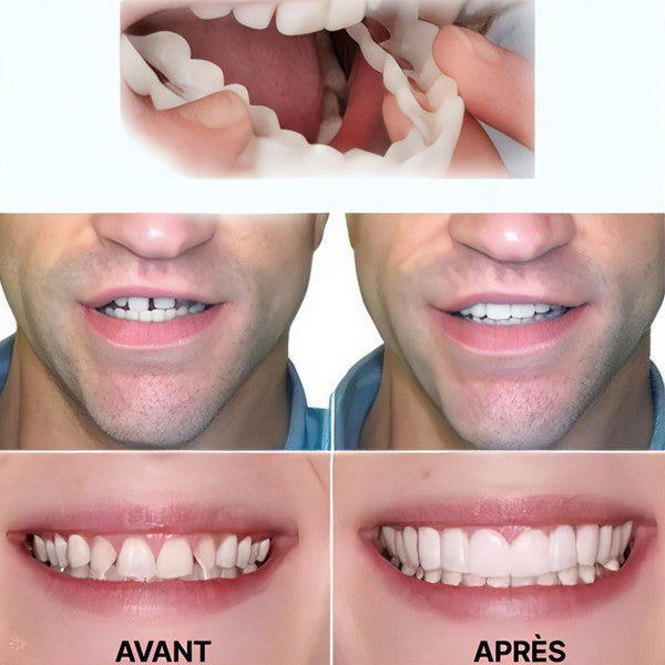 Facettes Dentaires à Clipser