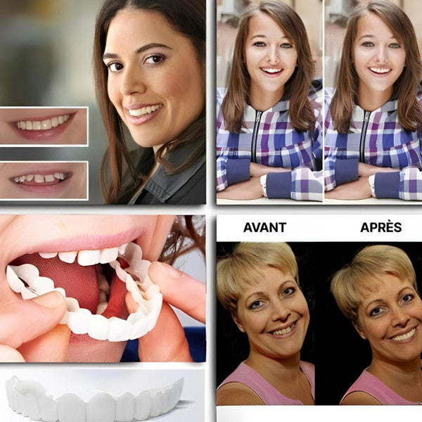 Facettes Dentaires à Clipser